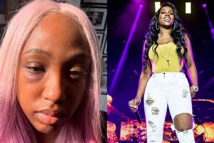 Brittney Taylor Shows Her Black Eye After Claiming Remy Ma Punched Her – See The Photo