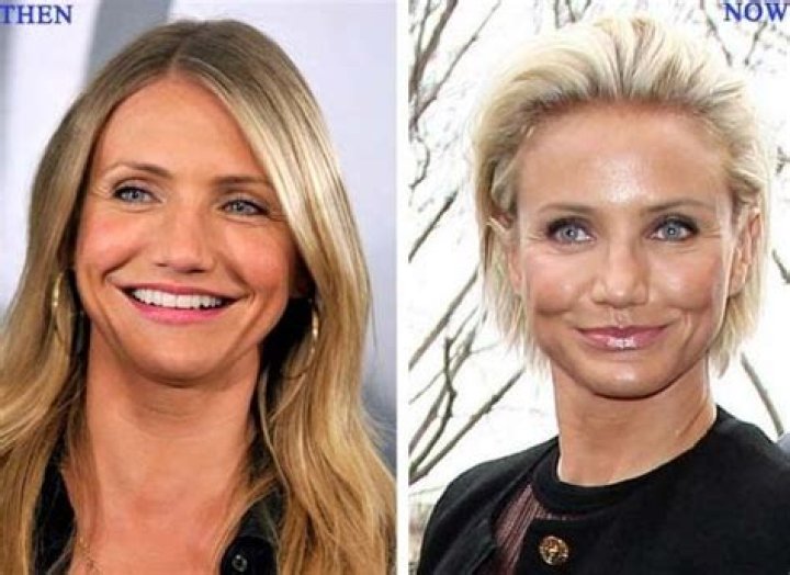 Cameron Diaz Plastic Surgery Before and After