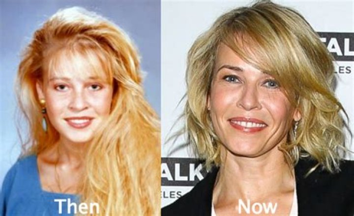 Chelsea Handler Plastic Surgery: Chelsea's Pro Fractional Laser Treatment to Overcome Skin Deficiencies!