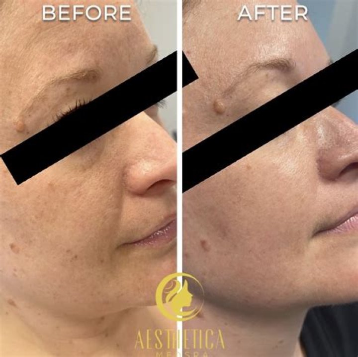 Chemical Peel Review