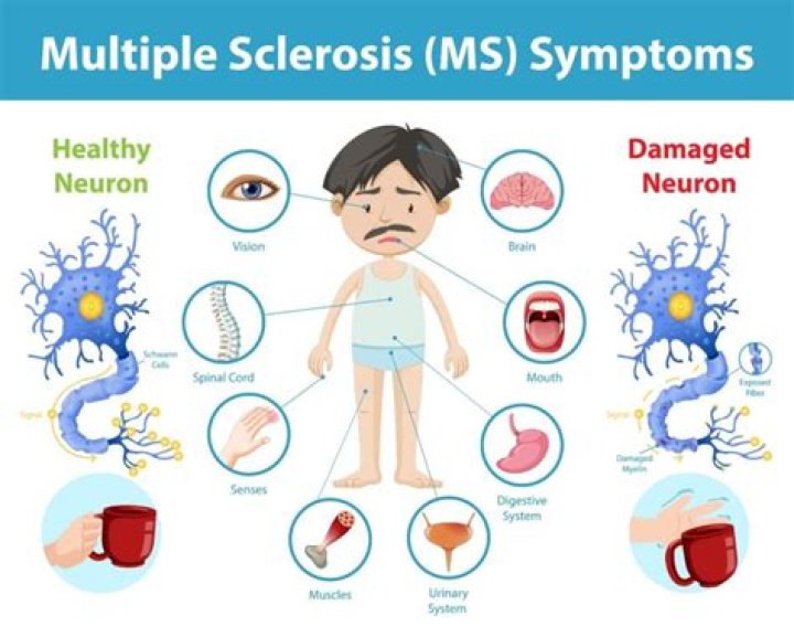Does Mira Sorvino have MS? Multiple sclerosis explained