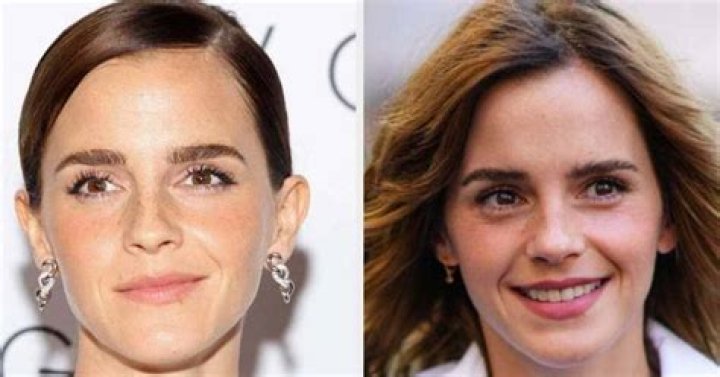 Emma Watson Nose Job Plastic Surgery Before and After