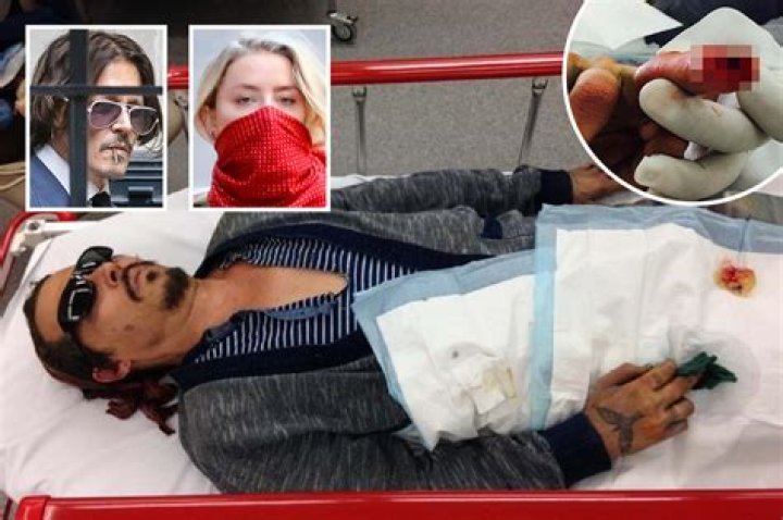 Johnny Depp finger tip cut off
