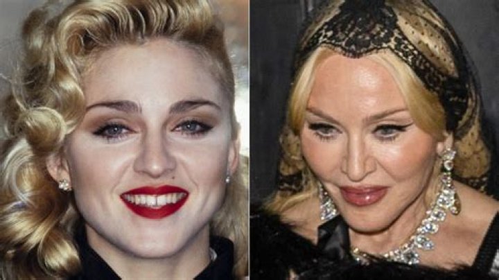 Madonna before and after plastic surgery pictures