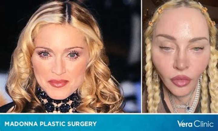 Madonna Plastic Surgery: From Fluffy Cheeks to Disappearing Dimples Everything that We Know!