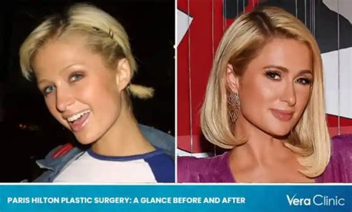 Paris Hilton Breast Implants Plastic Surgery Before and After