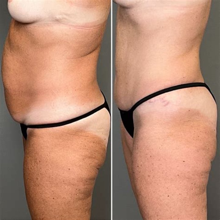 Dr. Philippe Capraro, MD – Denver, CO