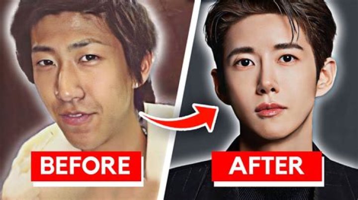 Shin Seul Ki Done Before and After Plastic Surgery Photo