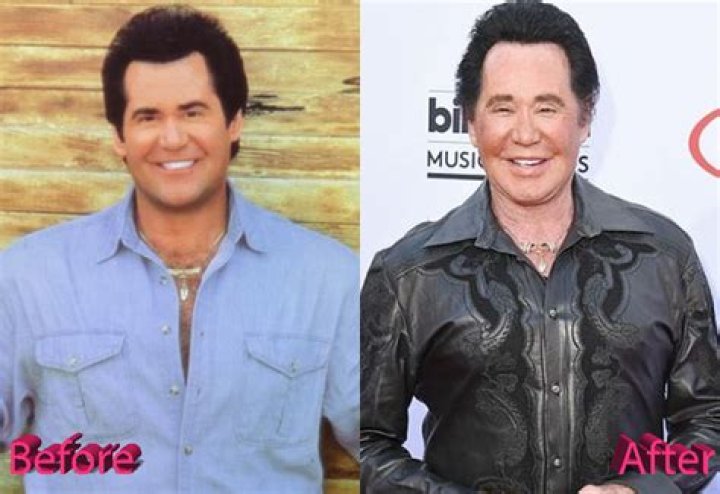 Wayne Newton Plastic Surgery: Is There Something Wrong with Wayne's Face?