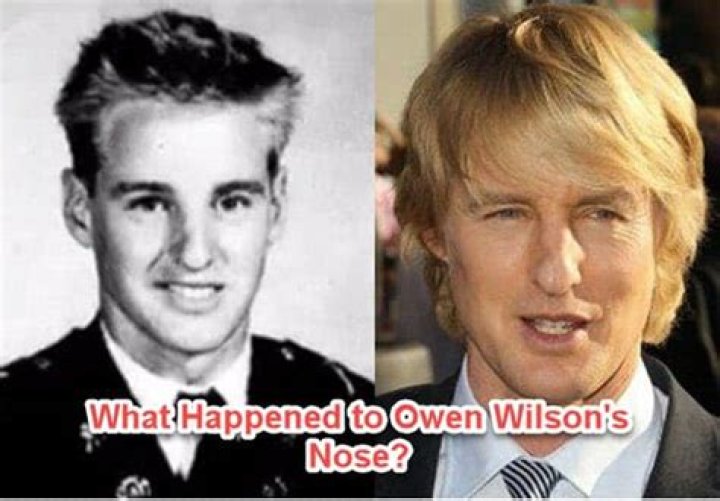 What Really Happened To Owen Wilson’s Nose And How Did He Break It?