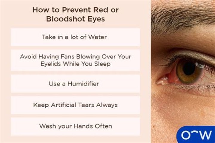 Why Are Troy Aikmans Eyes Ao Red? Fans Are concerned About The Bloodshot Eyes