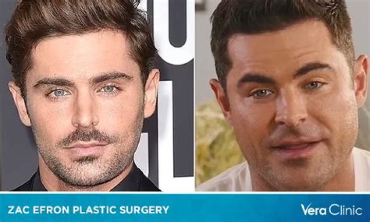 Zac Efron Undergoes ACL Surgery Following Injury On A Ski-Slope